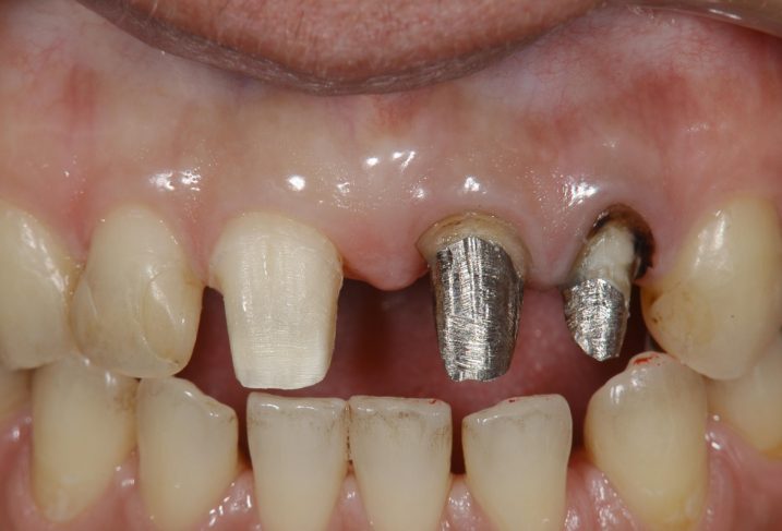 セラミッククラウンを用いた審美歯科治療を行う為に支台歯形成を行なった。歯肉縁上形成終了時