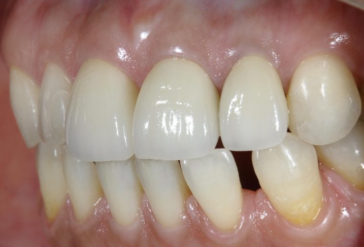 セラミック治療を行った後の写真、歯の幅、歯茎の高さが美しく揃った。