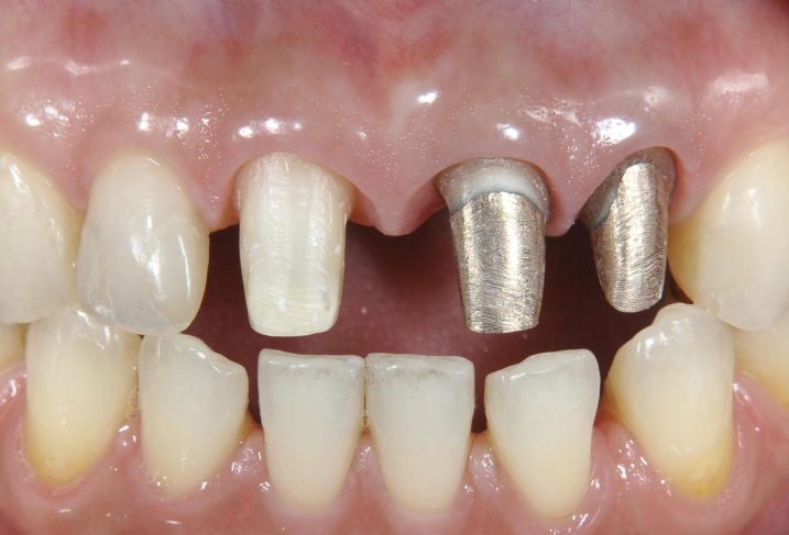 セラミッククラウンを用いた審美歯科治療を行う為に支台歯形成を行なった。歯肉縁下形成終了時