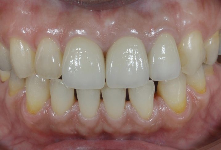 セラミック治療を行った後の写真、歯の幅、歯茎の高さが美しく揃った。