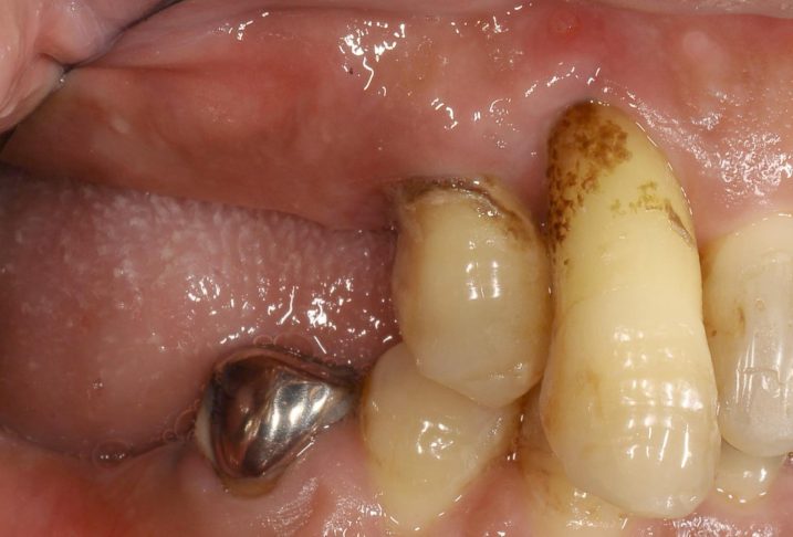 歯周病と欠損がある患者、インプラント、セラミック、歯周外科を予定している。