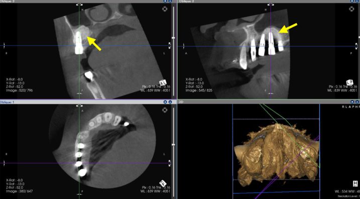 インプラント埋入、上顎洞底挙上術（サイナスリフト）を行い、CTで安全に確実に行われたことを確認した。