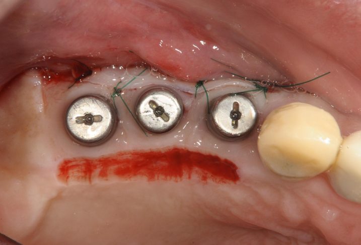 インプラントの２次手術後に付着歯肉の増大を狙って、グラフト手術を行なった。（咬合面観）