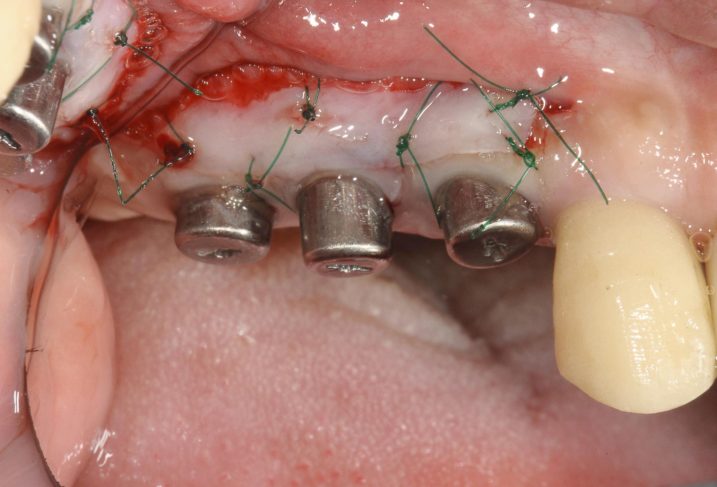インプラントの２次手術後に付着歯肉の増大を狙って、グラフト手術を行なった。