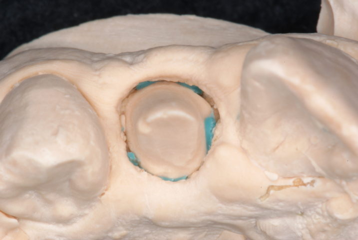 歯肉縁下形成後、圧排操作を行い、シリコン印象を行なった後の模型。