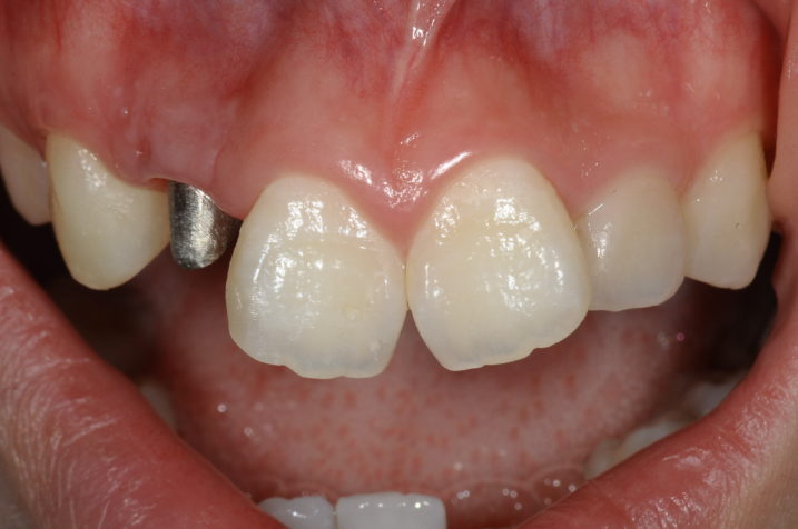 矯正的挺出と歯冠長延長術（クラウンレングスニング）を行い、メタルコア植立後に歯肉縁下形成を行なった。