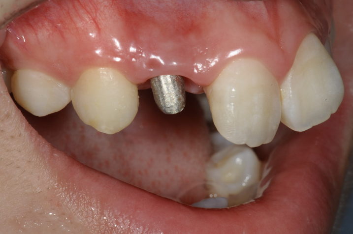 矯正的挺出と歯冠長延長術（クラウンレングスニング）を行い、メタルコア植立後に歯肉縁下形成を行なった。（側方面観）