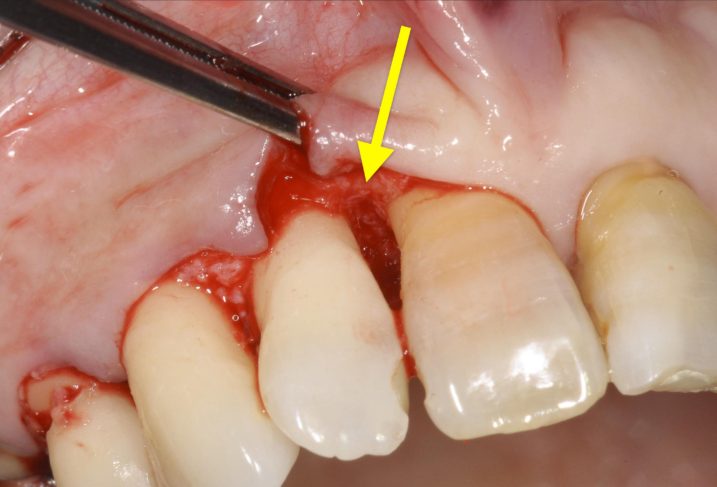 歯周病に対して歯周外科手術を行なった。ブラックトライアングルが生じないように細心の注意をはらいながら歯肉弁を取り扱う。