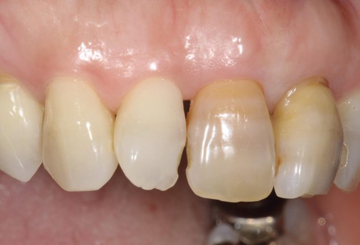歯周病に対して歯周外科手術を行う直前の側方面観