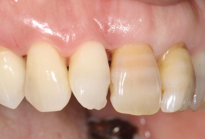 歯周外科手術から10日後の側方面観