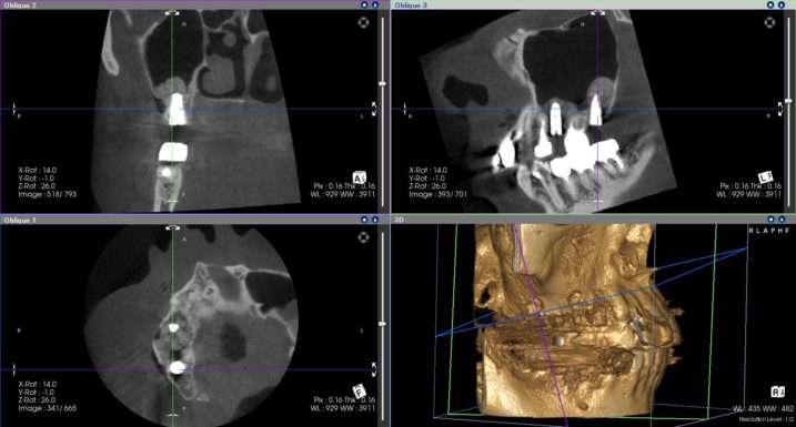 上顎右側臼歯に対して、上顎洞底挙上術（サイナスリフト）を行い、インプラントを埋入した後のCT画像