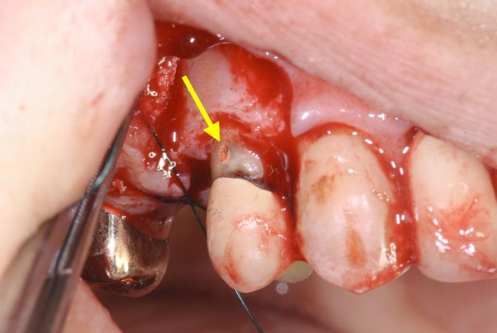 インプラントの手術中に歯根部にパーフォレーションが発見された。