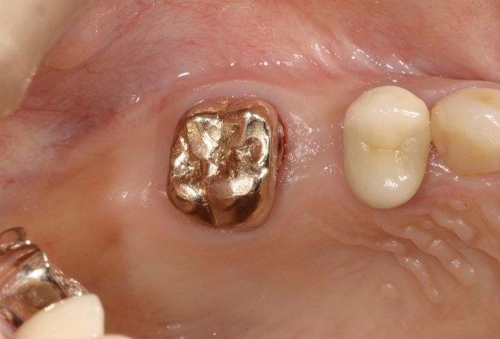 上顎右側臼歯に対して、インプラントとセラミック冠の治療を行う為に抜歯を行い、抜歯窩は治癒した（咬合面観）