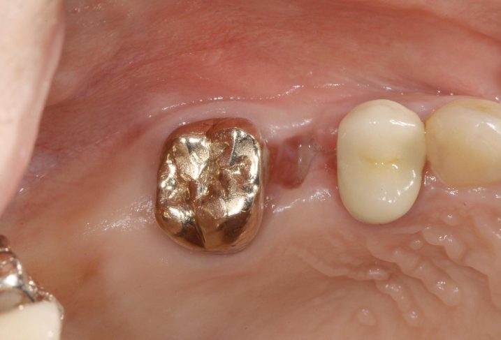 上顎右側臼歯に対して、インプラントとセラミック冠の治療を行う前の写真（咬合面観）