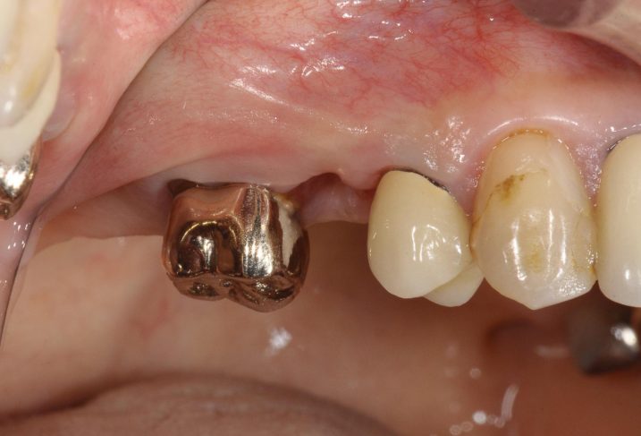 上顎右側臼歯に対して、インプラントとセラミック冠の治療を行う前の写真