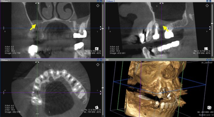 上顎右側臼歯に対して、インプラントとセラミック冠の治療を行う為に、CT撮影を行なった