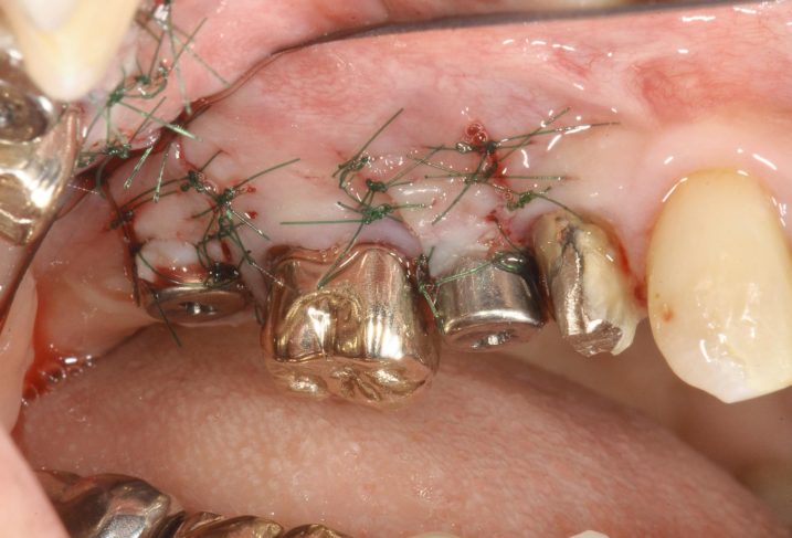 上顎右側臼歯部インプラントの２次手術。歯肉弁根尖側移動術を行い、付着歯肉の増大を狙った。