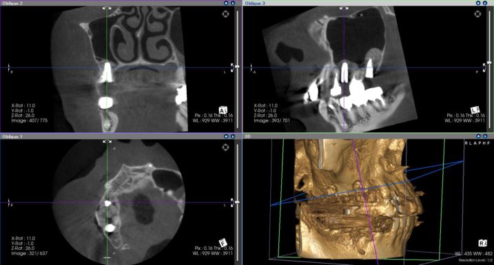 上顎右側臼歯に対して、上顎洞底挙上術（サイナスリフト）を行い、インプラントを埋入した後のCT画像