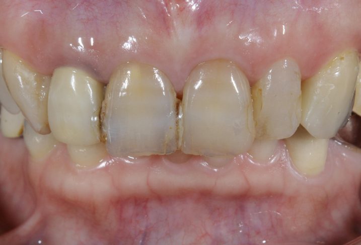 失活歯に対してセラミック冠を用いた審美歯科治療を行う前の写真