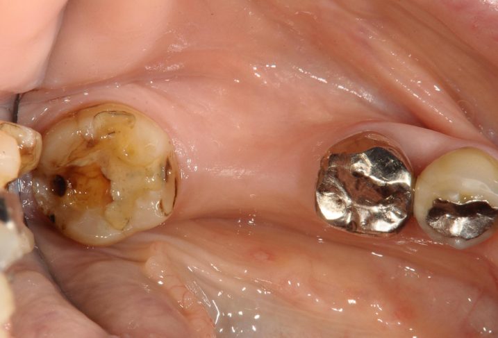 臼歯に対してセラミック・インプラントを行う前の写真