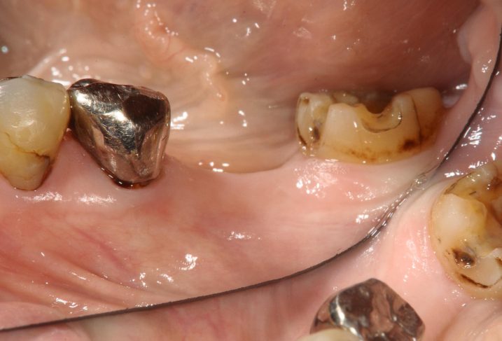 インプラントとセラミックを用いた臼歯部に審美歯科治療を行う前の写真