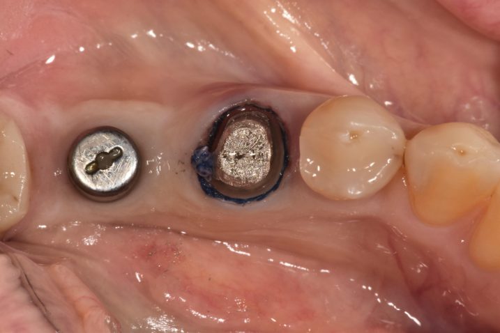 インプラント２次手術を終え、５番に対して支台歯形成を行い、印象採得の為に圧排操作を行なった。