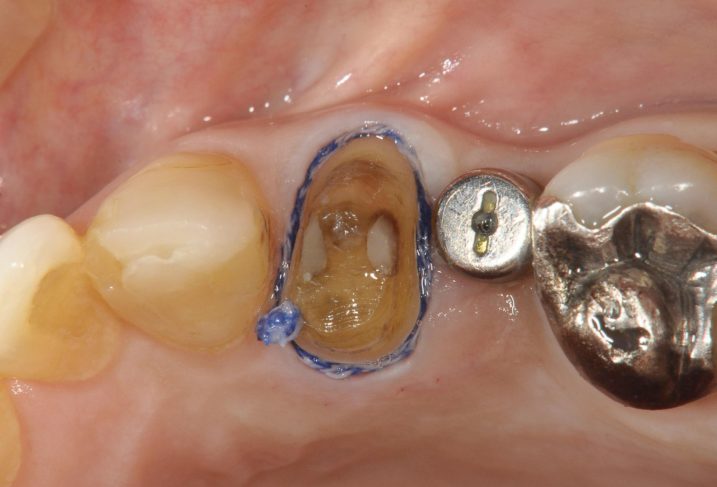 インプラントの２次手術を終え、４番に対して支台歯形成を行い、印象採得の為に圧排を行なった写真。