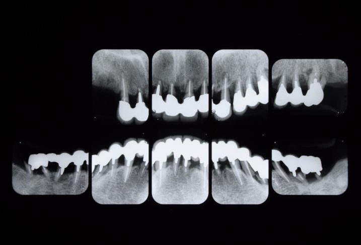 歯周病に対してインプラントと磁石義歯を用いた全顎治療を行う前のレントゲン写真