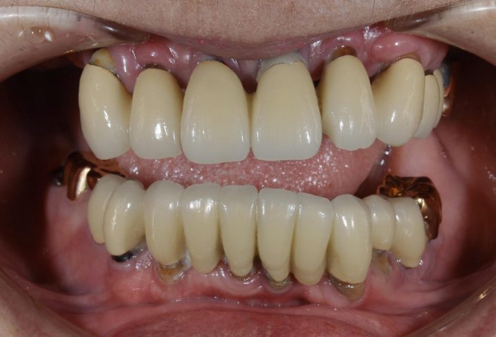 歯周病に対してインプラントと磁石義歯を用いた全顎治療を行う前の写真