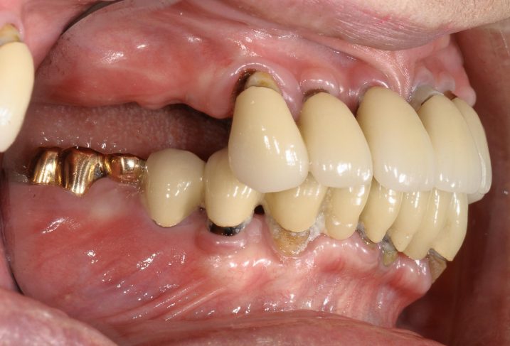 歯周病に対してインプラントと磁石義歯を用いた全顎治療を行う前の側方