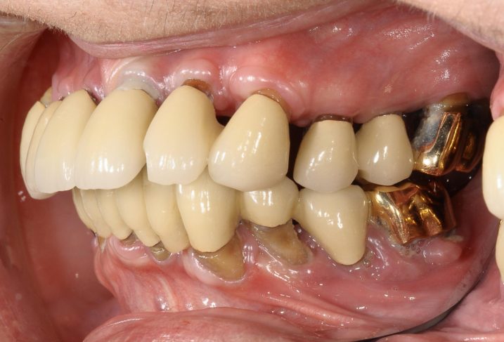 歯周病に対してインプラントと磁石義歯を用いた全顎治療を行う前の側方面