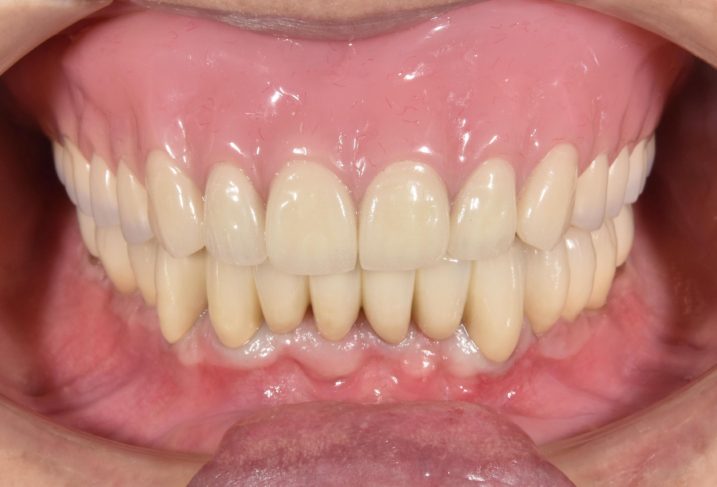 歯周病に対してインプラントと磁石義歯を用いて全顎治療を行なった。術後。