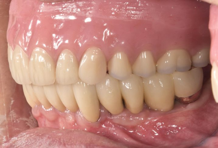 歯周病に対してインプラントと磁石義歯を用いた全顎治療を行った後の側方面