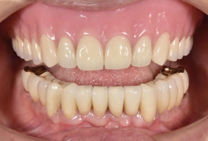 歯周病に対してインプラントと磁石義歯を用いた全顎治療を行った後の写真
