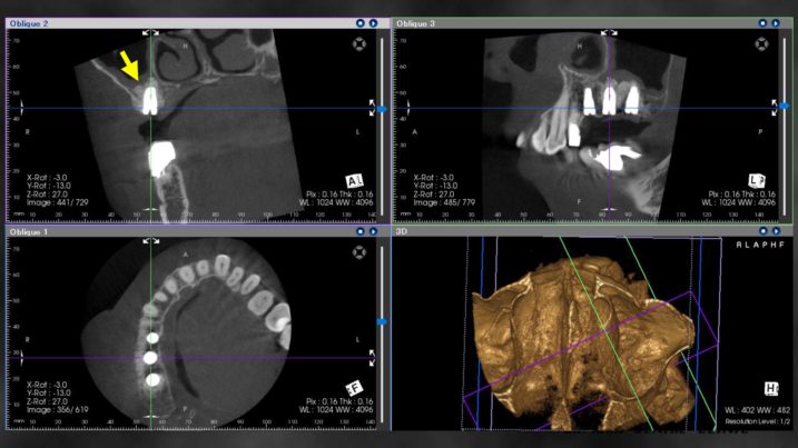 インプラント埋入後のCT
上顎洞底が確実に挙上されていることが確認できた