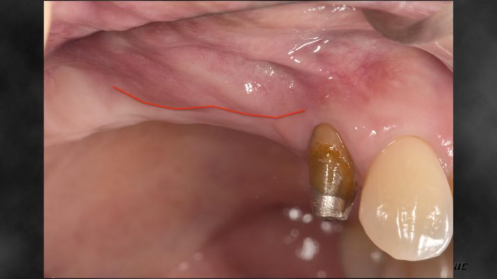 インプラント2次手術前、付着歯肉幅の確認
