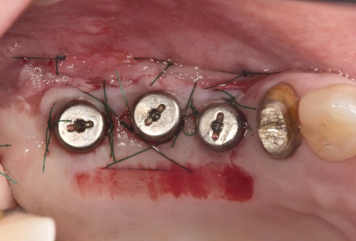 インプラント2次手術とグラフト手術を行い、付着歯肉幅の増大を狙う。（咬合面観）