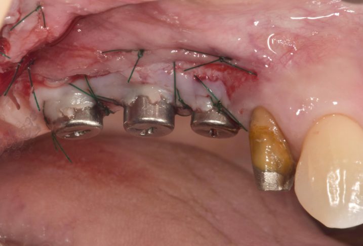 インプラント2次手術とグラフト手術を行い、付着歯肉幅の増大を狙う。（頬側面観）