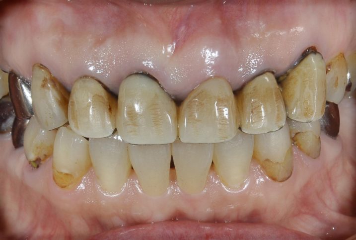 セラミック・インプラントによる審美歯科治療を行う前の写真