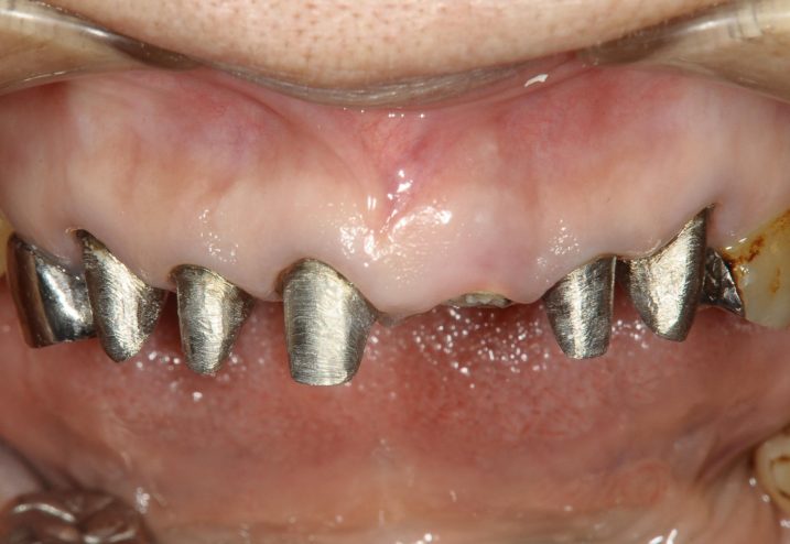 セラミック・インプラントによる審美歯科治療を行っている最中の写真
