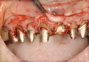 歯冠長延長術（クラウンレングスニング）の写真