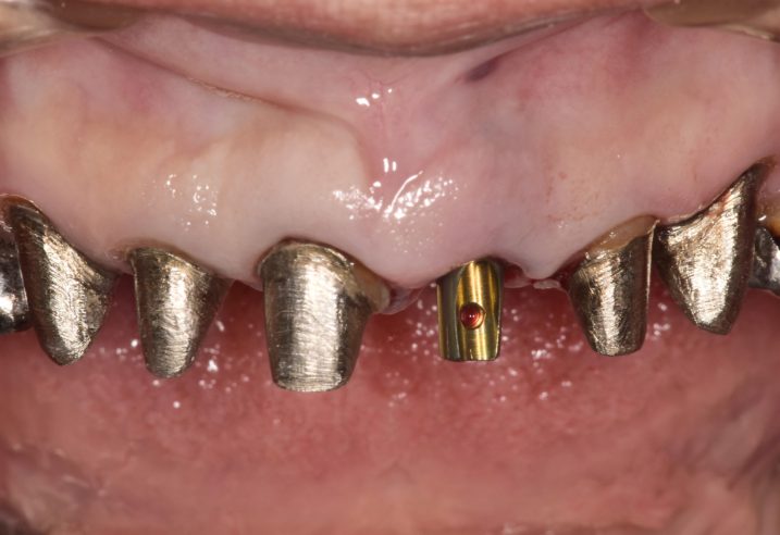 歯冠長延長術と上顎前歯部にインプラントの埋入を行なった後の写真