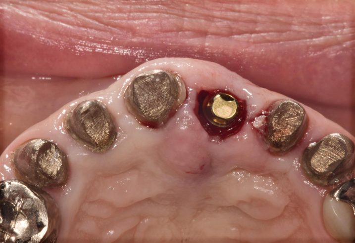 歯冠長延長術と上顎前歯部にインプラントの埋入を行なった後の写真（咬合面観）