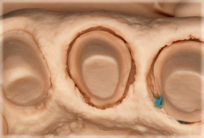 支台歯の模型