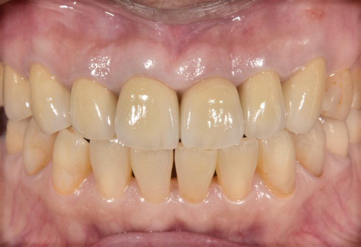 セラミック・インプラントによる審美歯科治療を行なった後の写真