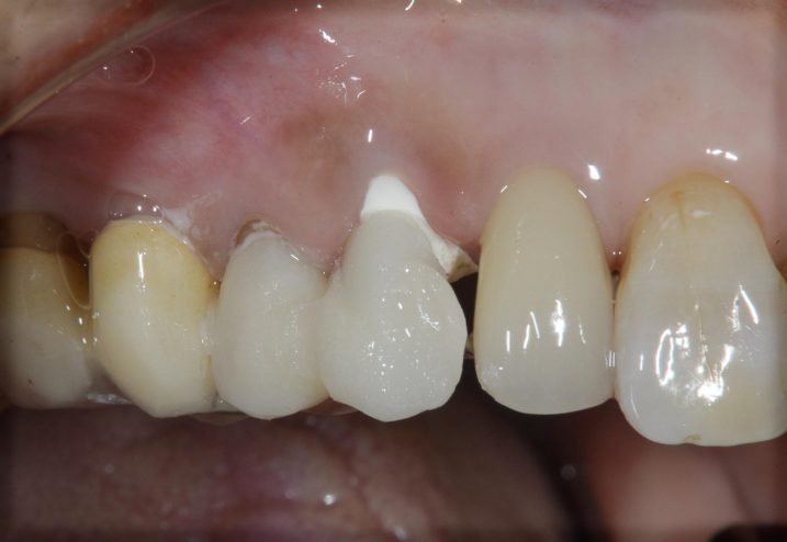 深い虫歯に対して矯正的挺出を行なっている際の仮歯