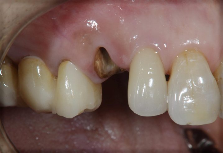 深い虫歯に対して矯正的挺出と歯冠長延長術を用いて治療した審美歯科治療を行う前の写真