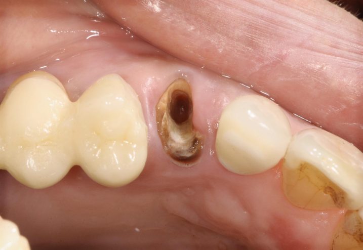 深い虫歯に対して矯正的挺出と歯冠長延長術を用いて治療した審美歯科治療を行う前の写真　咬合面観