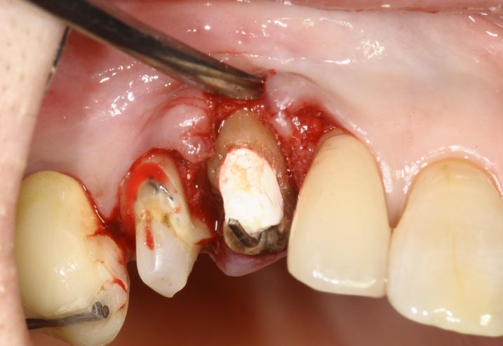 深い虫歯に対して矯正的挺出を行い、歯冠長延長術を行なっている写真