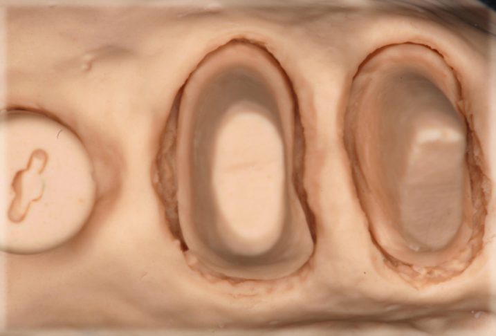 支台歯の模型